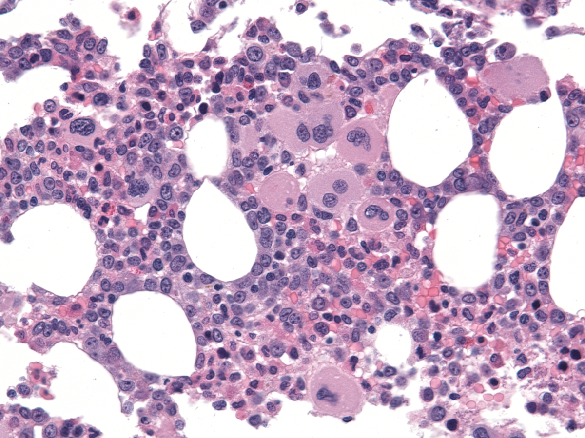 bone marrow core biopsy with blasts and dysplastic megakaryocytes